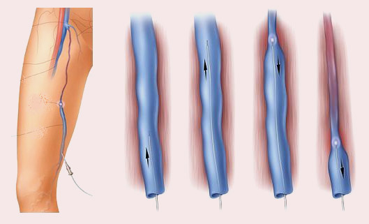 Как лечить варикоз вен